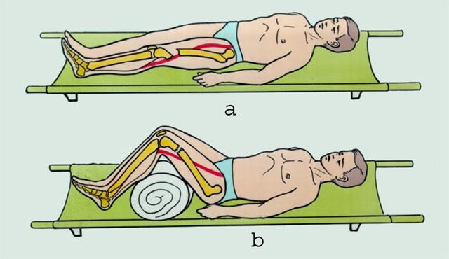 Бедро. Укладка пострадавшего с переломом бедренной кости