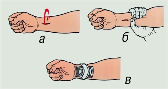 Предплечье. Остановка кровотечения из лучевой артерии
