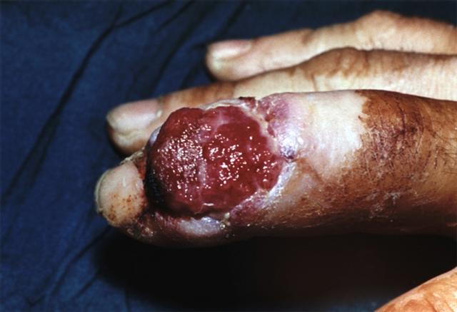 Панариций. Костно-суставной панариций межфалангового сустава