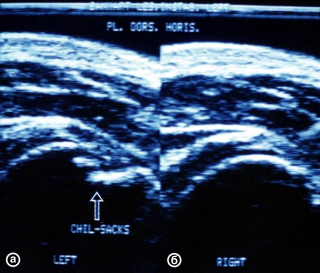 Ультрасонограммы плечевых суставов