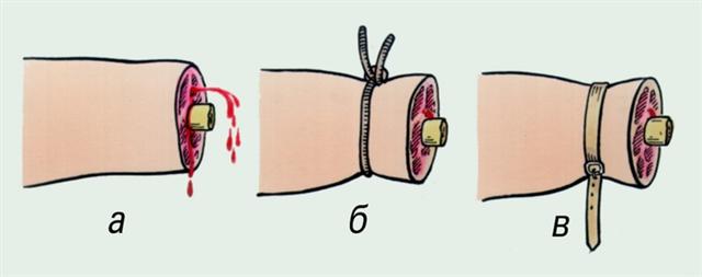 Отрыв, отсечение конечностей. Остановка кровотечения