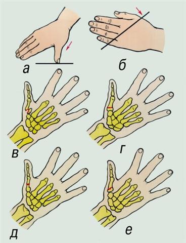 Кисть. Механизмы травмы и виды переломов I пястной кости