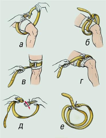 Кровотечение. Использование поясного ремня в качестве кровоостанавливающего жгута