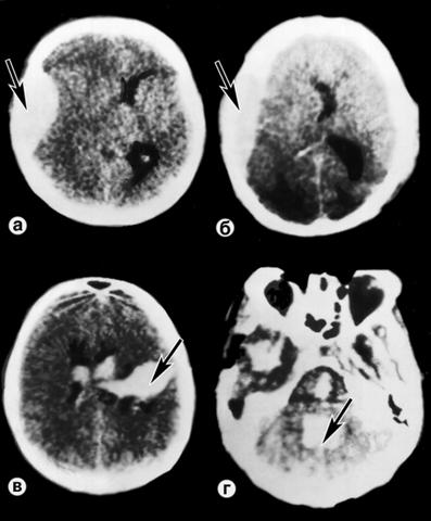 Компьютерные томограммы при черепно-мозговой травме, сопровождающейся компрессией головного мозга
