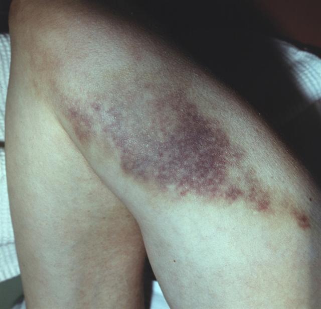 Бедро. Подкожная гематома наружной поверхности