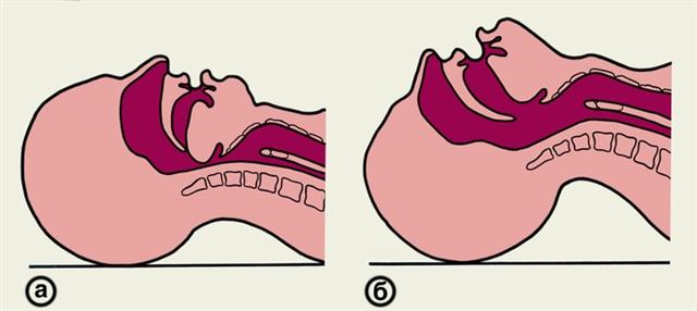 Схематическое изображение верхних дыхательных путей при неправильном и правильном положении головы больного