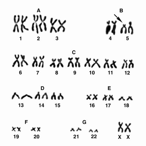 Хромосомный набор больной с синдромом Лежена