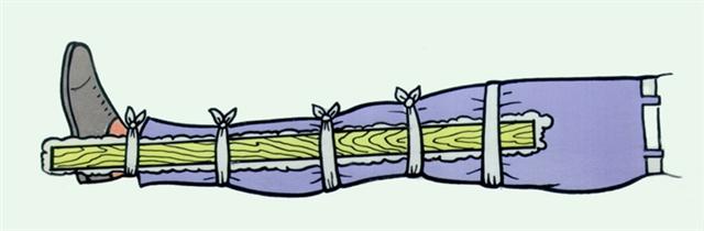 Голень. Транспортная иммобилизация при переломе