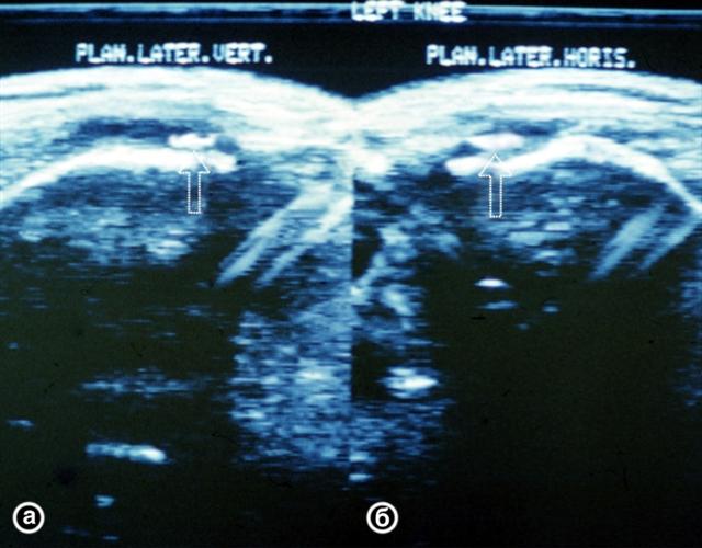 Ультрасонограмма коленных суставов при паракапсулярном разрыве внутреннего мениска и в норме