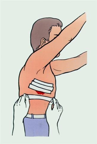 Грудь. Лейкопластырная повязка при ранении