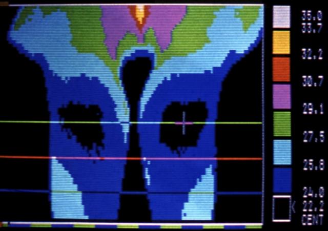 Термограмма коленных суставов при их анкилозе