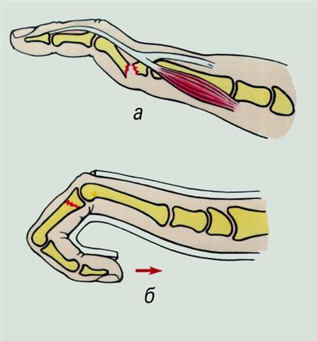 Кисть. Перелом фаланги с образованием угловой деформации