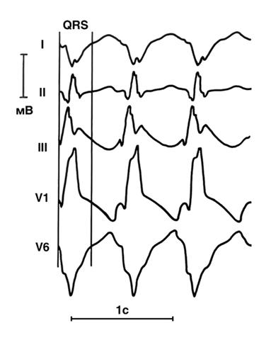 Электрокардиограмма при пароксизмах желудочковой тахикардии