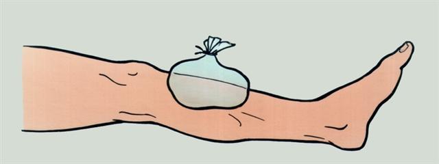 Голень. Наложение пакета со льдом в области ушиба