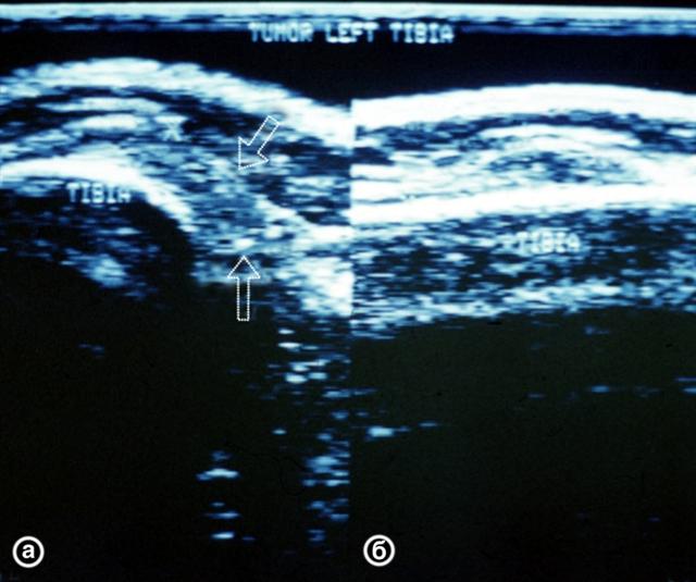 Ультрасонограммы верхней трети левой голени при околосуставной мягкотканной опухоли