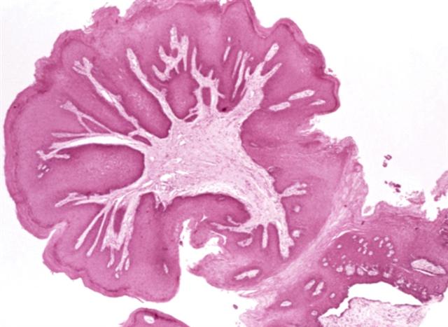 Микропрепарат плоскоклеточной папилломы языка