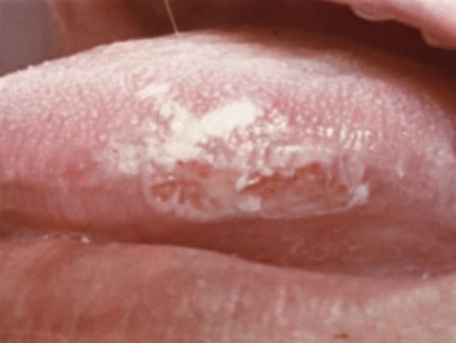 Очаги поражения на языке при эрозивной форме лейкоплакии
