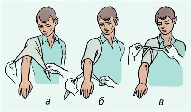 Плечевой сустав. Наложение косыночной повязки