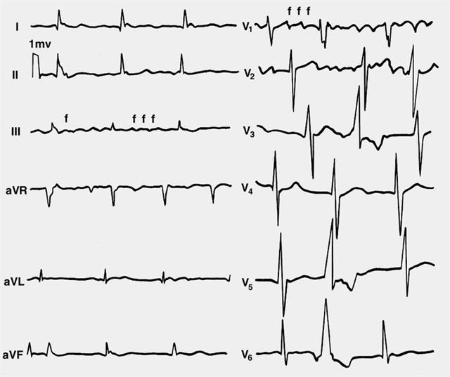 Электрокардиограммы при крупноволновой форме мерцательной аритмии