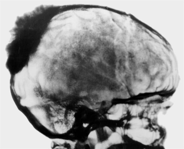 Боковая рентгенограмма черепа больного при остеогенной саркоме теменно-затылочной области