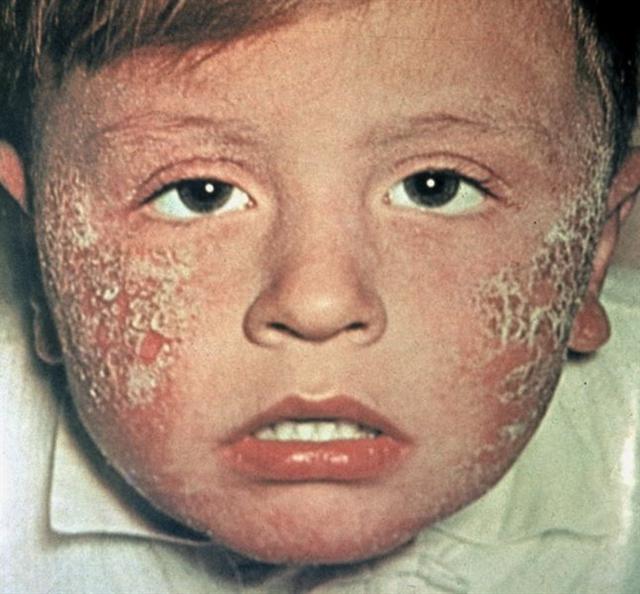 Кожа. Аллергический дерматит, вызванный эритромицином