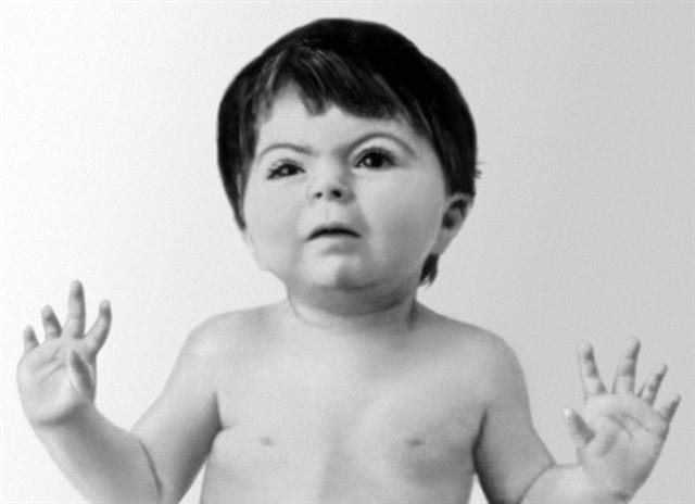 Внешние проявления синдрома де Ланге