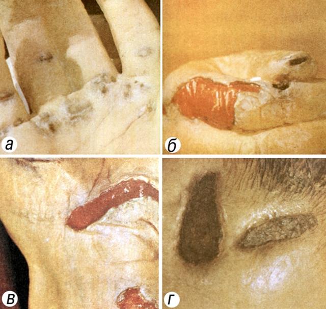 Электротравма. Электроожоги кожи различной степени