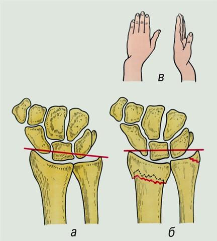Предплечье. Линия между вершинами шиловидных отростков
