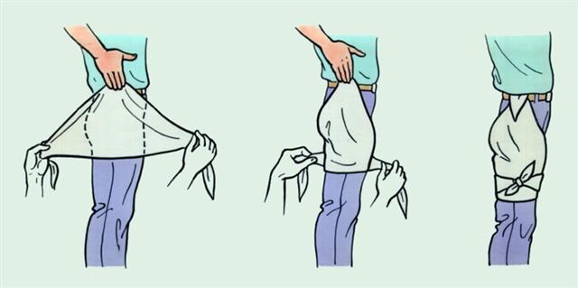 Бедро. Наложение косыночной повязки