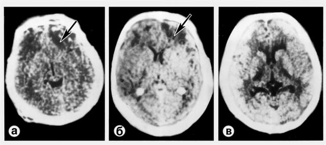 Компьютерные томограммы при тяжелом ушибе левой лобной доли и диффузном аксональном повреждении мозга
