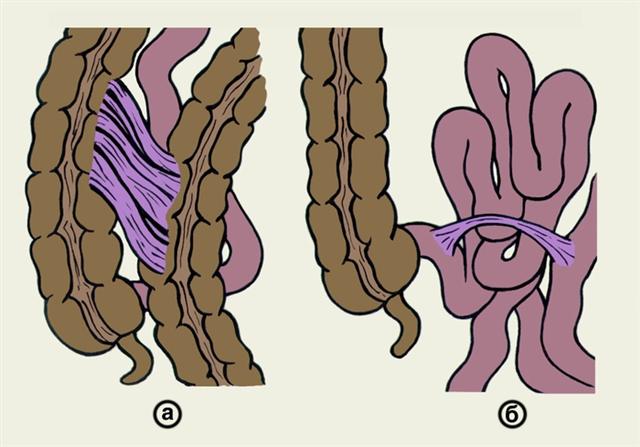 Схематическое изображение плоскостных и тяжевых внутрибрюшинных спаек
