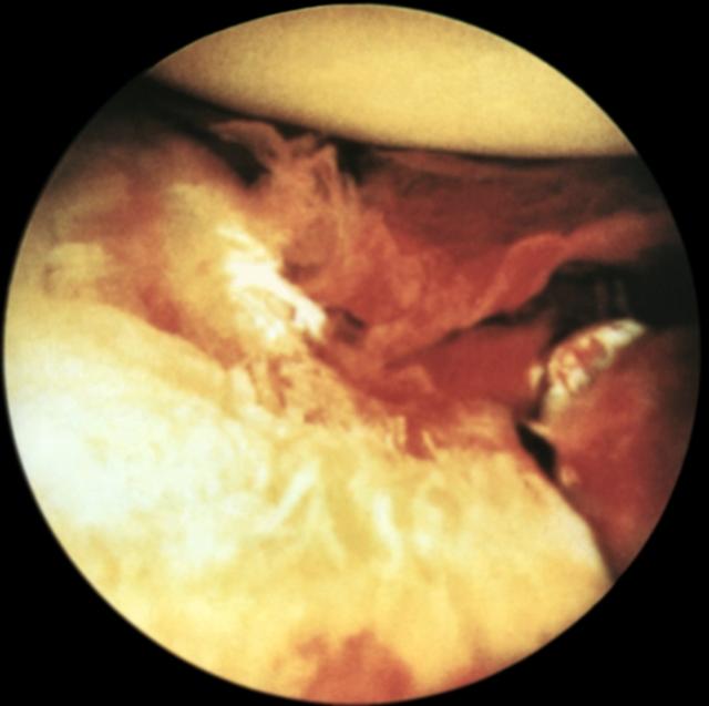 Артроскопическая картина при полном свежем разрыве большеберцовой коллатеральной связки