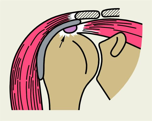 Схематическое изображение плечевого сустава при тендините надостной мышцы