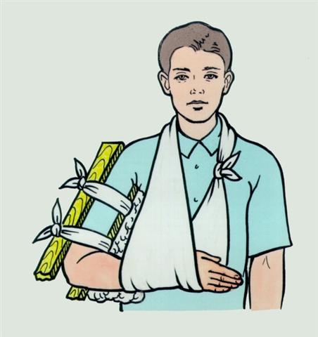 Плечо. Иммобилизация верхней конечности