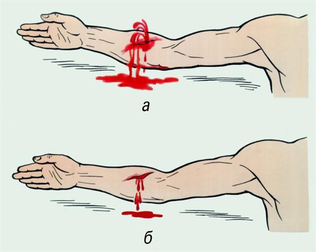 Виды кровотечения