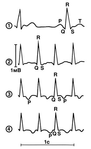 ЭКГ во втором стандартном отведении при синусовом ритме и разных видах суправентрикулярной пароксизмальной тахикардии
