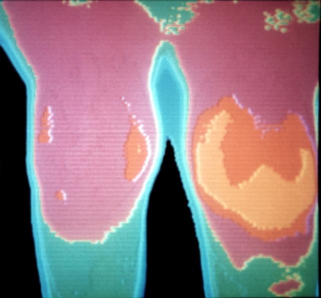 Термограмма коленных суставов при левостороннем гемартрозе