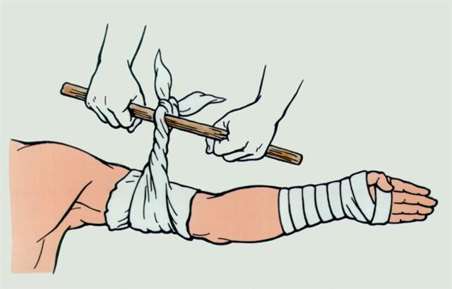 Предплечье. Остановка кровотечения жгутом-закруткой