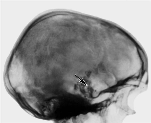 Боковая рентгенограмма черепа больного с хордомой основания черепа без признаков гипертензии
