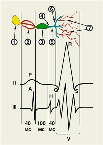 Схема соотношения между элементами электрокардиограммы и внутрисердечной электрограммы (гисограммы)