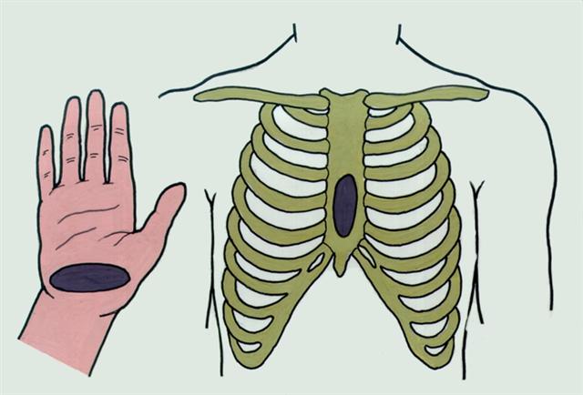 Массаж сердца. Место соприкосновения руки и грудины при непрямом массаже