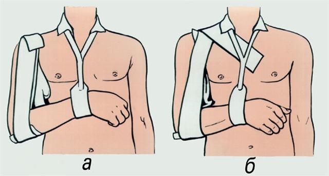 Иммобилизация верхней конечности при вывихе ключицы