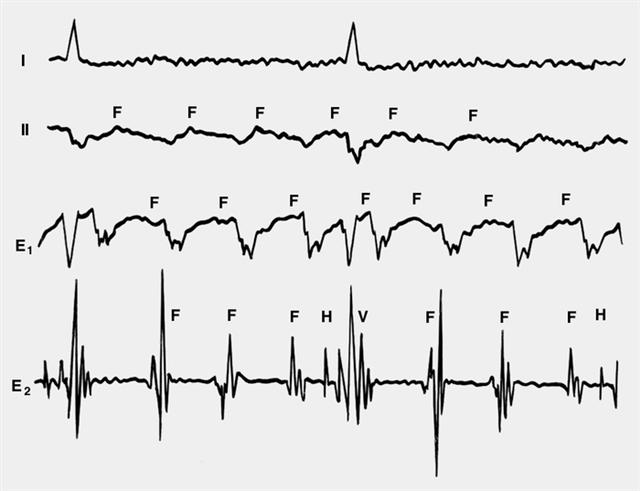 Электрокардиограммы в отведениях I и II и внутрисердечные электрограммы в отведениях Е1 и Е2