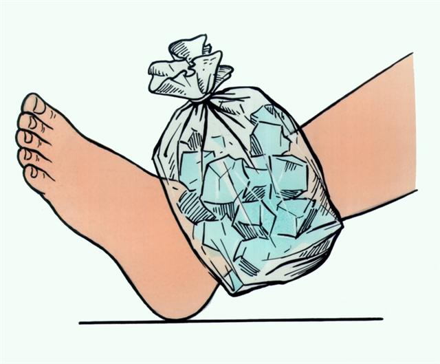 Голеностопный сустав. Наложение пакета со льдом при растяжении связок