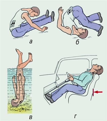 Позвоночник. Механизм травмы при переломе