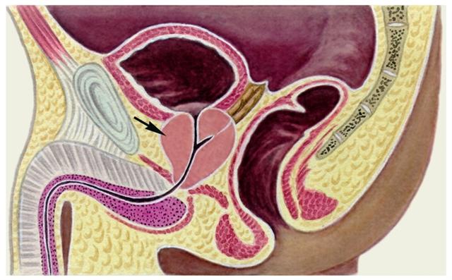Схематическое изображение сагиттального разреза таза мужчины при аденоме предстательной железы