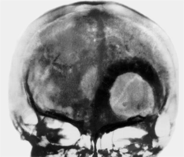 Переднезадняя рентгенограмма черепа больного с метастазом рака паращитовидной железы в чешую лобной кости слева