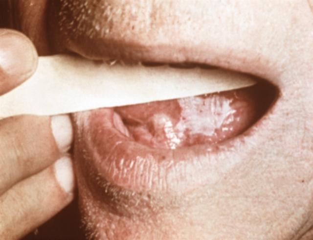 Очаг поражения в виде беловатой пленки на нижней поверхности при простой лейкоплакии