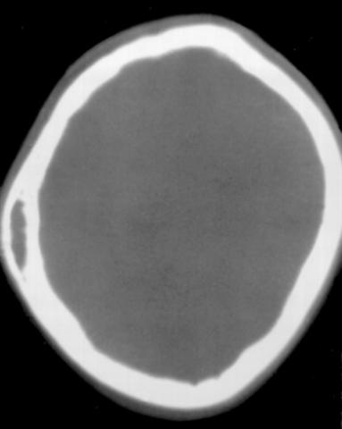 Аксиальная компьютерная томограмма (в костном режиме) при гемангиоме левой теменной кости