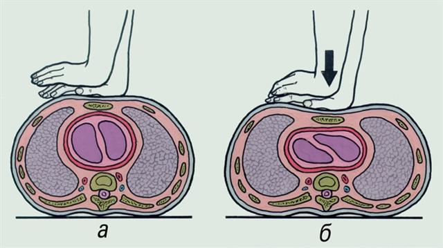 Массаж сердца. Схема непрямого массажа